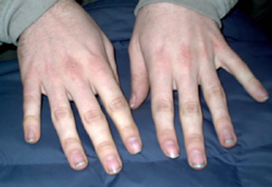 dirty fingernails