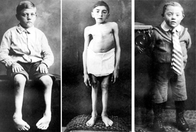 Black and white photographs of deformed and retarded children