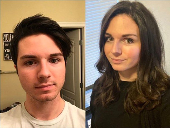 MTF face changes with the aid of feminizing hormones