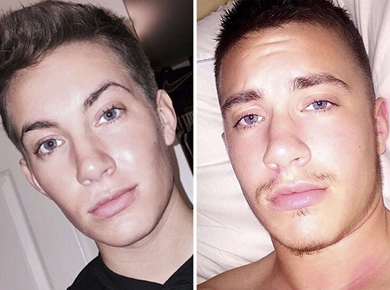 FTM transgender Jaimie Wilson's facial changes from Testosterone