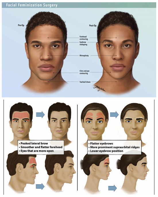 Examples of facial surgery procedures for transgenders
